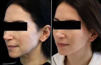 52 year old before and 3 months after an extended neck lift with Dr. Maia in Tysons Corner, VA