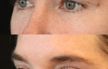 50 year-old before and 4 months after eye rejuvenation (Upper Eyelid Lift, CO2 Laser, Fat Grafting, and Nanofat Grafting under the Eyes)