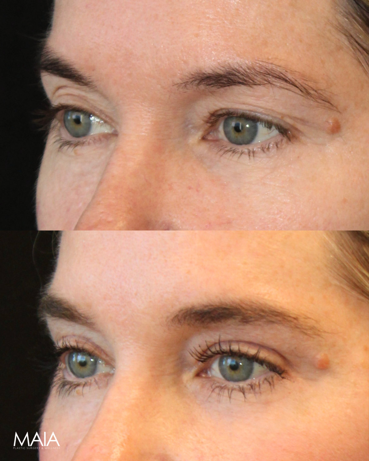 50 year-old before and 4 months after eye rejuvenation (Upper Eyelid Lift, CO2 Laser, Fat Grafting, and Nanofat Grafting under the Eyes)