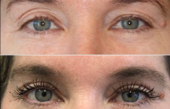 50 year-old before and 4 months after eye rejuvenation (Upper Eyelid Lift, CO2 Laser, Fat Grafting, and Nanofat Grafting under the Eyes)