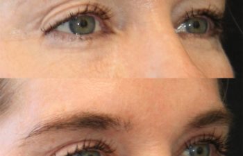 50 year-old before and 4 months after eye rejuvenation (Upper Eyelid Lift, CO2 Laser, Fat Grafting, and Nanofat Grafting under the Eyes)