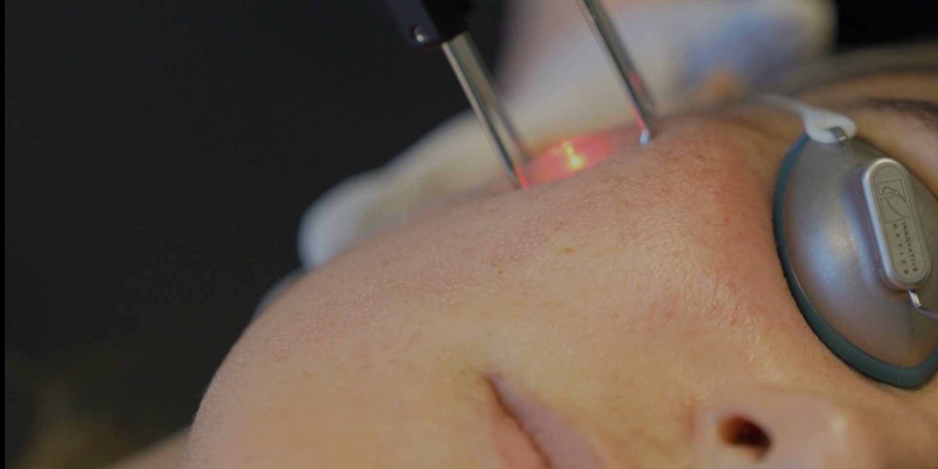 Laser treatment being performed on facial skin with protective eye shield during a medspa procedure