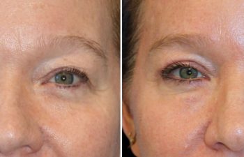 52 year old 3 months after upper eyelid lift, temple lift, and osteoma removal with Dr. Maia in Tysons Corner, VA
