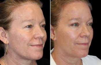 52 year old 3 months after upper eyelid lift, temple lift, and osteoma removal with Dr. Maia in Tysons Corner, VA