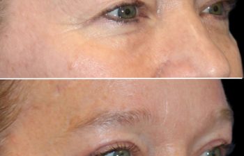 52 year old 3 months after upper eyelid lift, temple lift, and osteoma removal with Dr. Maia in Tysons Corner, VA