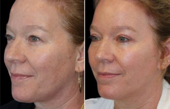 52 year old 3 months after upper eyelid lift, temple lift, and osteoma removal with Dr. Maia in Tysons Corner, VA