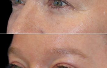 52 year old 3 months after upper eyelid lift, temple lift, and osteoma removal with Dr. Maia in Tysons Corner, VA