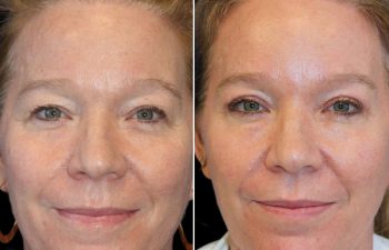 52 year old 3 months after upper eyelid lift, temple lift, and osteoma removal with Dr. Maia in Tysons Corner, VA
