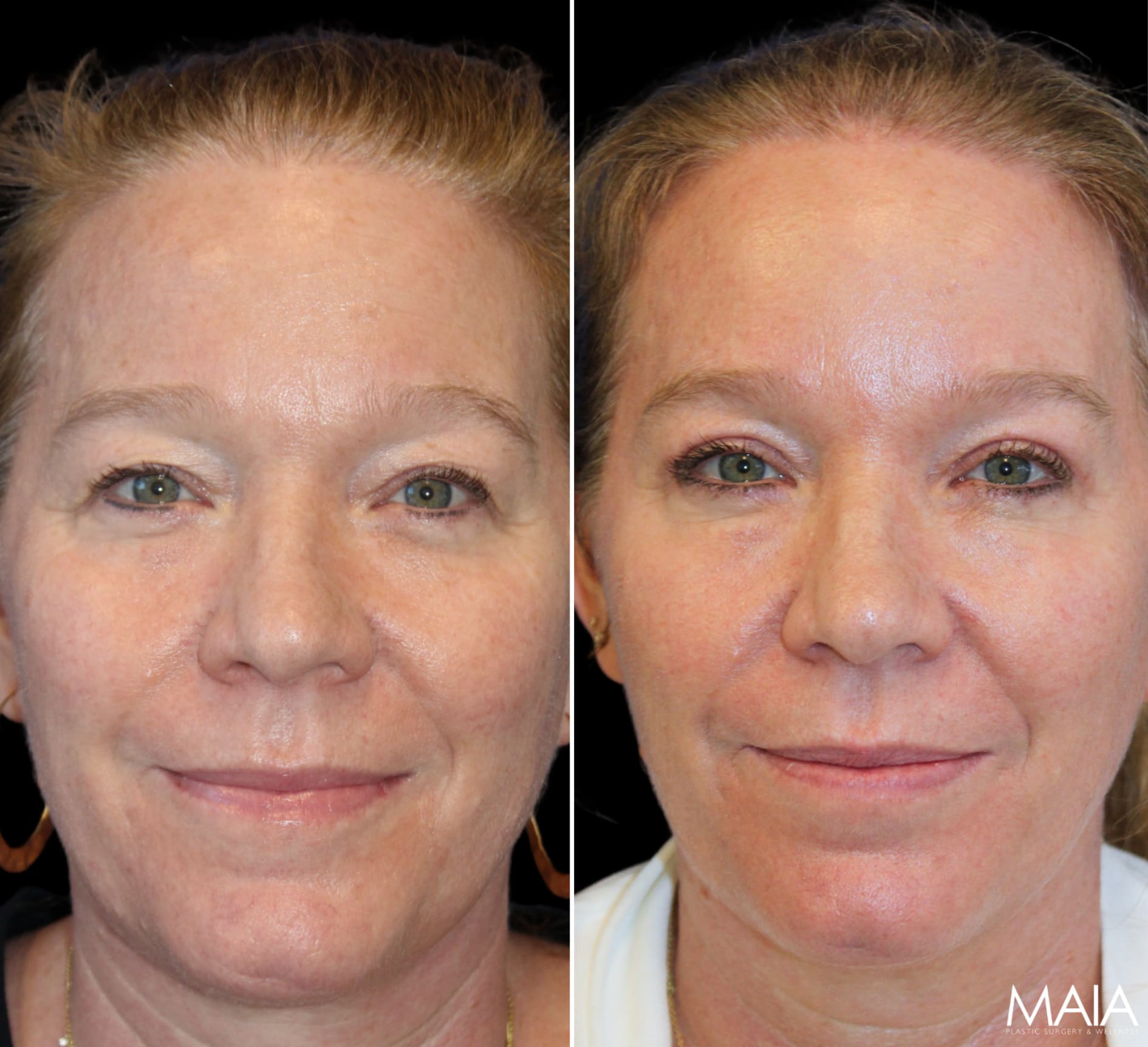 52 year old 3 months after upper eyelid lift, temple lift, and osteoma removal with Dr. Maia in Tysons Corner, VA