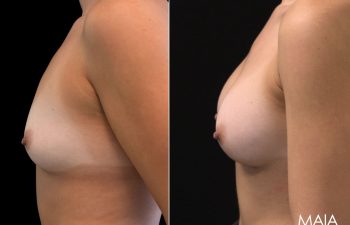 25 year-old before and 7.5 weeks after breast augmentation (300 cc)