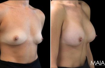 25 year-old before and 7.5 weeks after breast augmentation (300 cc)