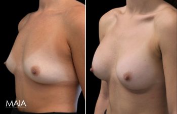 25 year-old before and 7.5 weeks after breast augmentation (300 cc)