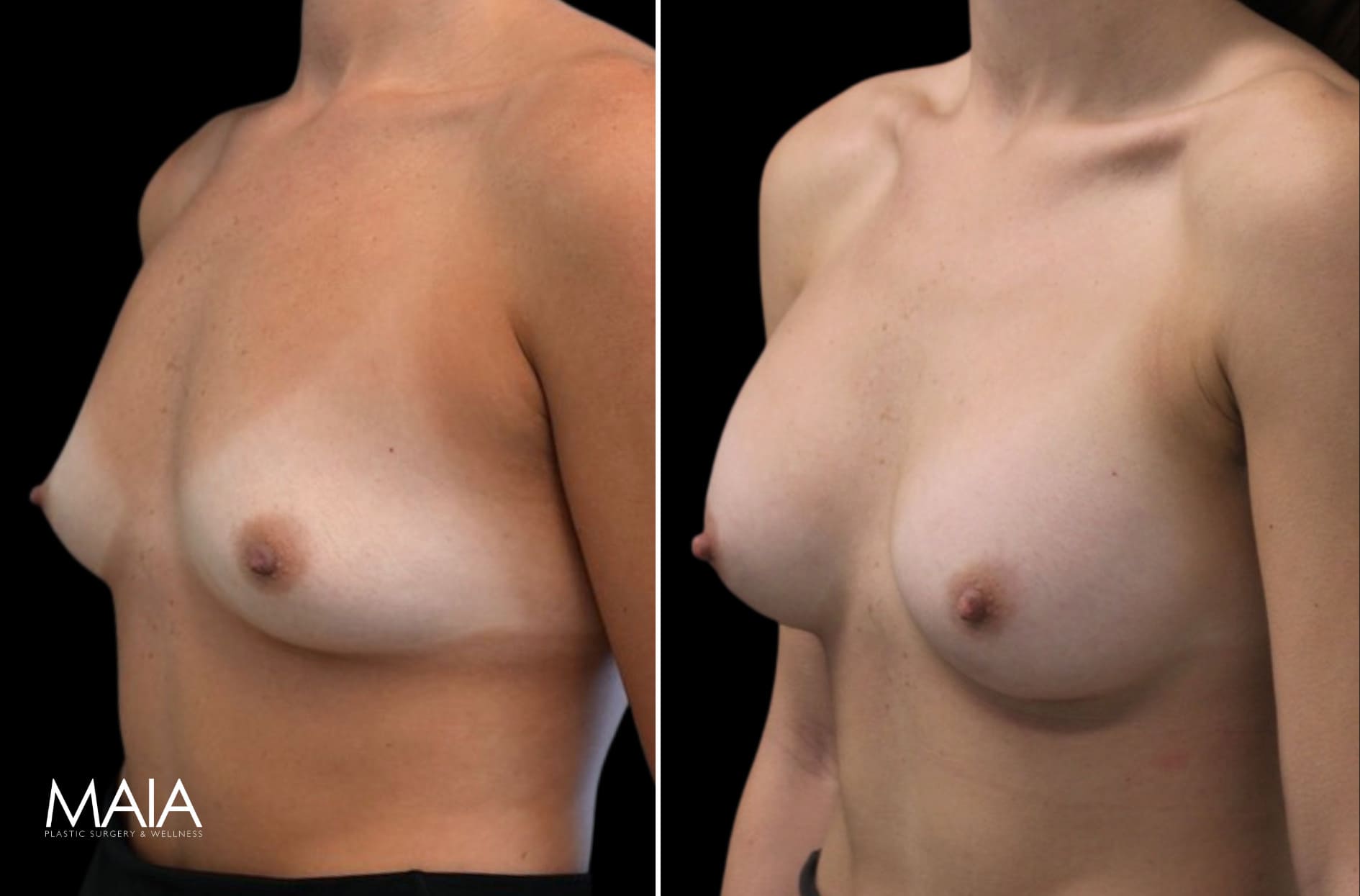25 year-old before and 7.5 weeks after breast augmentation (300 cc)