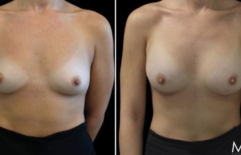 25 year-old before and 7.5 weeks after breast augmentation (300 cc)