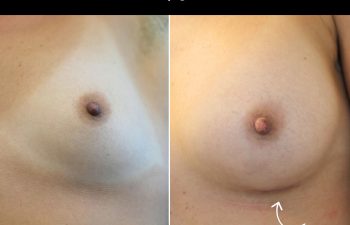 25-year-old patient, 7.5 weeks after breast augmentation (300 cc), showing surgical scar healing at 7.5 weeks post-op