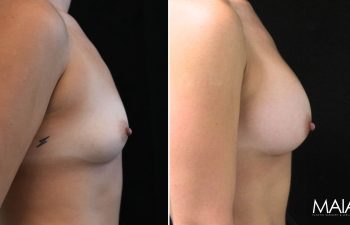25 year-old before and 7.5 weeks after breast augmentation (300 cc)