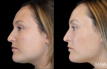 28 Year-Old Before and After Neuromodulators and 3 Sessions of Clear+Brilliant