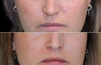 28 Year-Old Before and After Neuromodulators and 3 Sessions of Clear+Brilliant