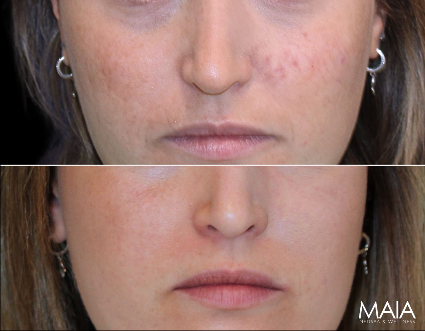 28 Year-Old Before and After Neuromodulators and 3 Sessions of Clear+Brilliant