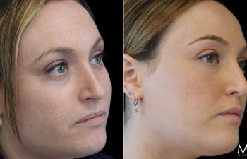 28 Year-Old Before and After Neuromodulators and 3 Sessions of Clear+Brilliant