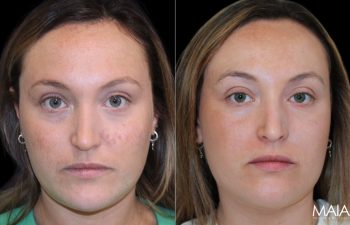 28 Year-Old Before and After Neuromodulators and 3 Sessions of Clear+Brilliant