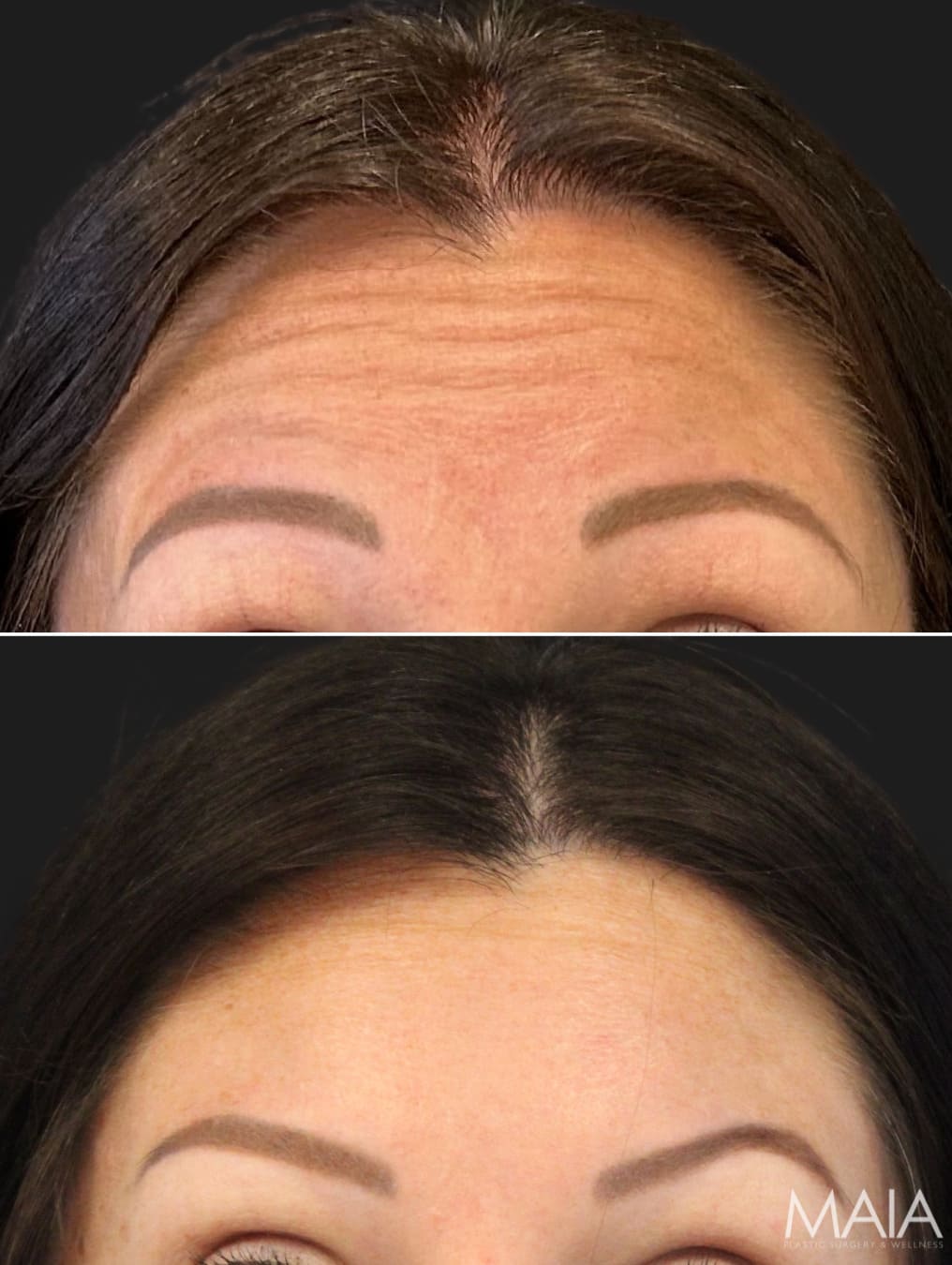 36 year old before and 3 weeks after Dysport to the forehead and glabella