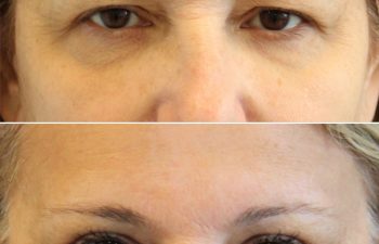 55 year-old before and 2.5 months after eyelid lift and mini temple lift with Dr. Maia in Tysons Corner, VA