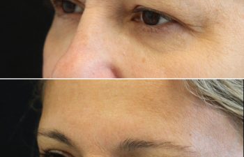 55 year-old before and 2.5 months after eyelid lift and mini temple lift with Dr. Maia in Tysons Corner, VA