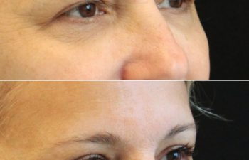 55 year-old before and 2.5 months after eyelid lift and mini temple lift with Dr. Maia in Tysons Corner, VA