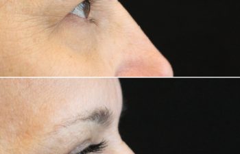 55 year-old before and 2.5 months after eyelid lift and mini temple lift with Dr. Maia in Tysons Corner, VA