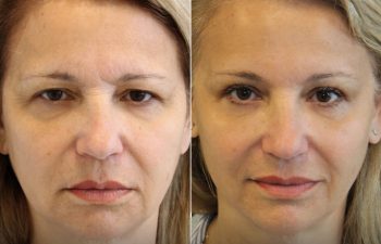 55 year-old before and 2.5 months after eyelid lift and mini temple lift with Dr. Maia in Tysons Corner, VA