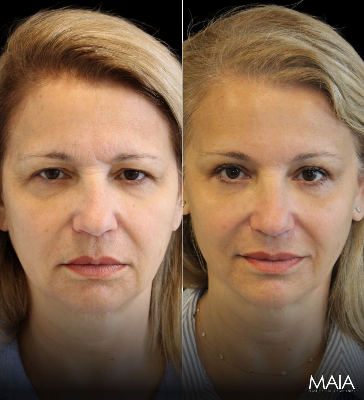 55 year-old before and 2.5 months after eyelid lift and mini temple lift with Dr. Maia in Tysons Corner, VA