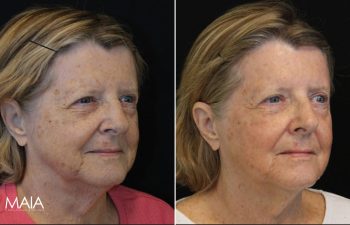 70 year-old patient before and 11 days after BBL+HALO (1 Session)