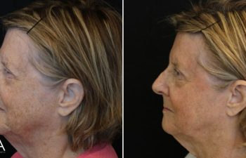 70 year-old patient before and 11 days after BBL+HALO (1 Session)