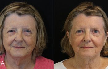 70 year-old patient before and 11 days after BBL+HALO (1 Session)