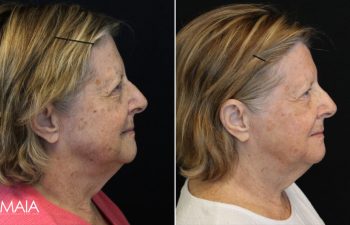 70 year-old patient before and 11 days after BBL+HALO (1 Session)