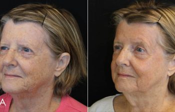 70 year-old patient before and 11 days after BBL+HALO (1 Session)