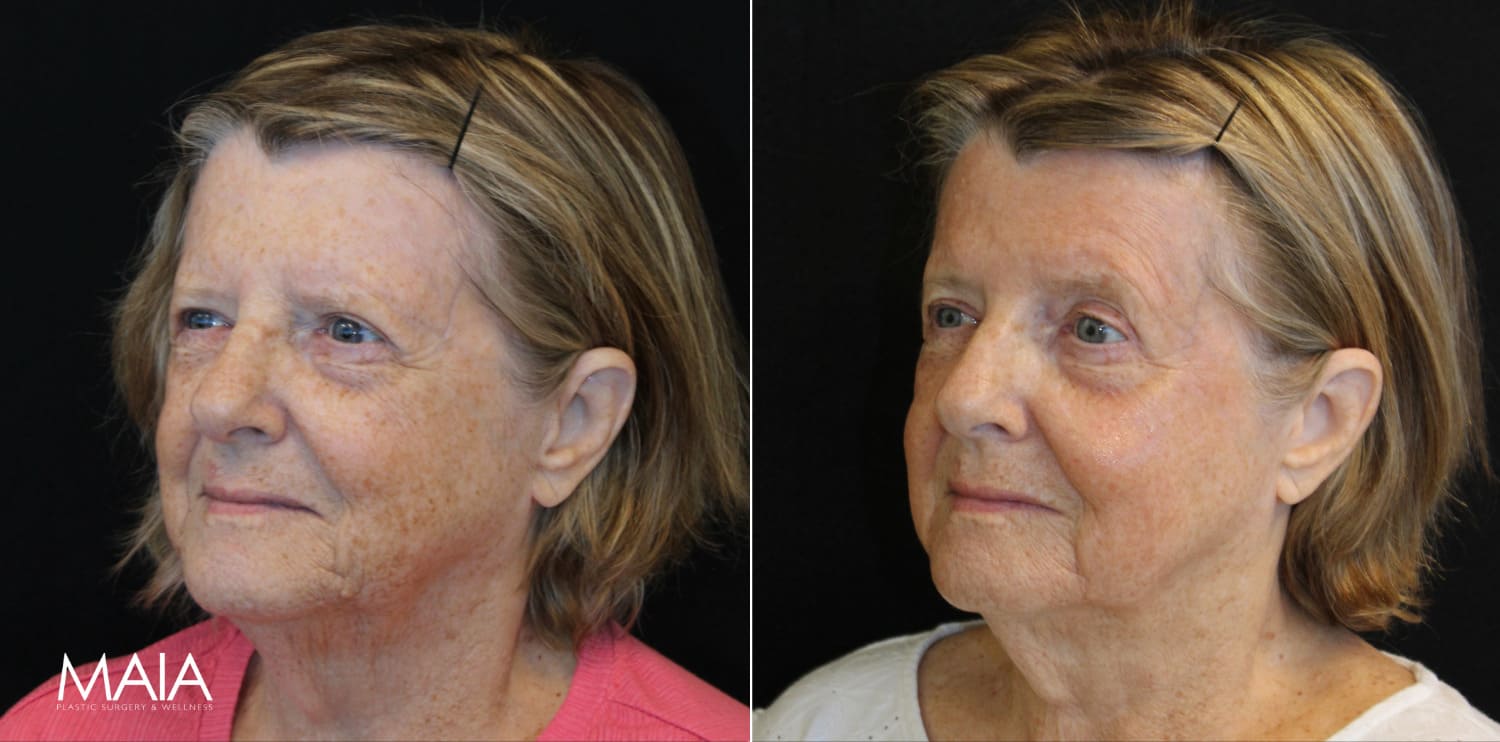 70 year-old patient before and 11 days after BBL+HALO (1 Session)