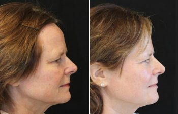 Side-by-side profile photos of a woman before and after a cosmetic procedure, showing smoother skin and a more defined jawline in the after image.