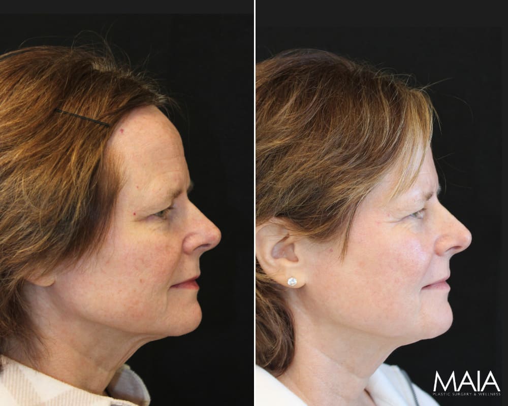 Side-by-side profile photos of a woman before and after a cosmetic procedure, showing smoother skin and a more defined jawline in the after image.