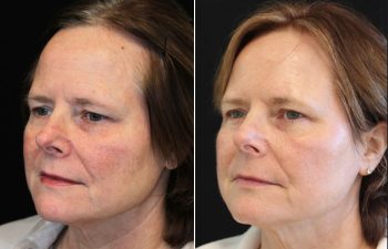 Side-by-side comparison of a woman’s face before and after a skin treatment, showing reduced redness and smoother complexion in the after image.