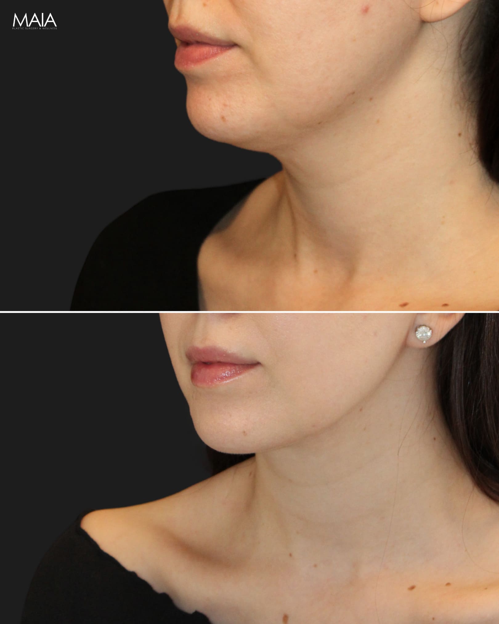 35 Year-Old Before and 6 Weeks After Neck Liposuction (Double Chin Lipo) With Dr. Munique Maia in Tysons Corner