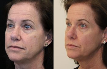 Side-by-side comparison of a middle-aged woman’s face before and after a cosmetic procedure, showing smoother skin and reduced wrinkles in the after image.