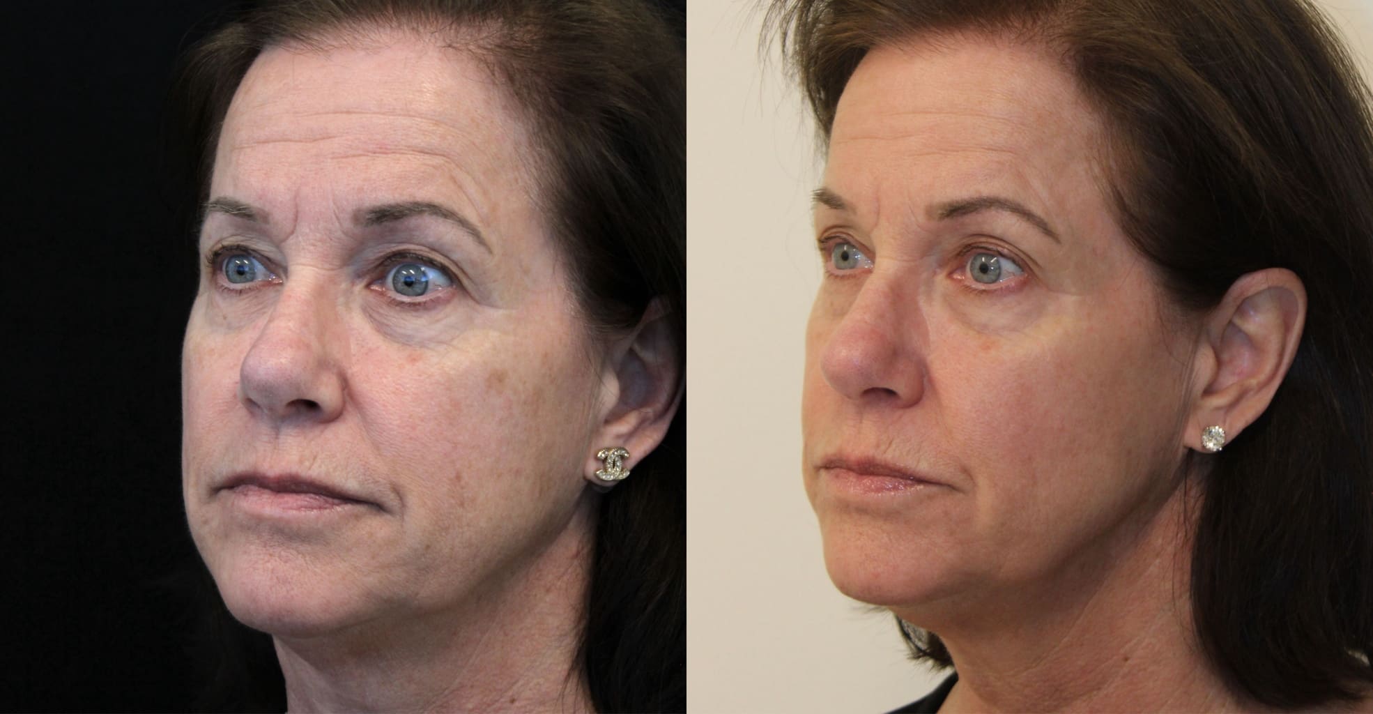 Side-by-side comparison of a middle-aged woman’s face before and after a cosmetic procedure, showing smoother skin and reduced wrinkles in the after image.