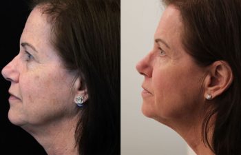 Side-by-side profile photos of a middle-aged woman before and after a cosmetic procedure, showing reduced sagging skin and a more defined jawline in the "after" image.