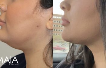 28 year-old before and 3 months after awake neck liposuction with Dr. Maia in Tysons Corner