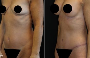 Side-by-side comparison of a woman's torso before and after cosmetic surgery, showing changes in breast and abdominal areas. Black circles and triangles cover private areas for privacy.