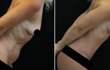 Side-by-side comparison of a woman's torso before and after an abdominal cosmetic procedure, showing reduced loose skin and improved contour in the after image.