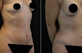 Side-by-side photos show a woman's torso before and after a surgical procedure, with visible changes in contour and scars. Sensitive areas are censored for privacy.