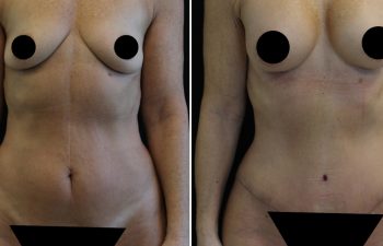 Side-by-side before-and-after photo of a woman showing changes in breast size and abdomen, likely from cosmetic surgery; identifying features are censored.